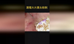 清理黑头粉刺视频,跟我学视频清洁术